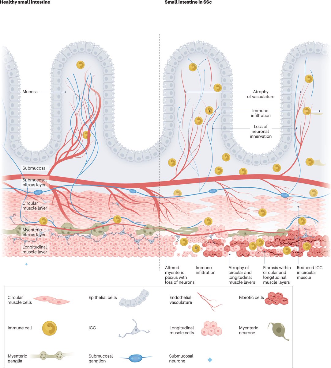 #MarchIssue | Read our #Review of systemic sclerosis gastrointestinal disease, discussing existing and emerging therapies, and promising directions for future research

go.nature.com/3ZmQ3ib