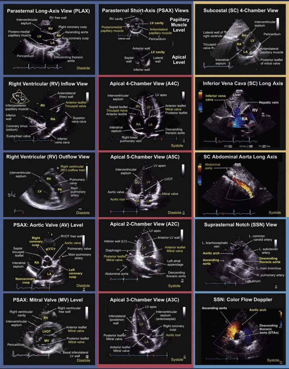 #echofirst views
#POCUS #MedEd #IMPOCUS #FOAMed #Emergency #Cardiology 
Source 🔗thoracickey.com