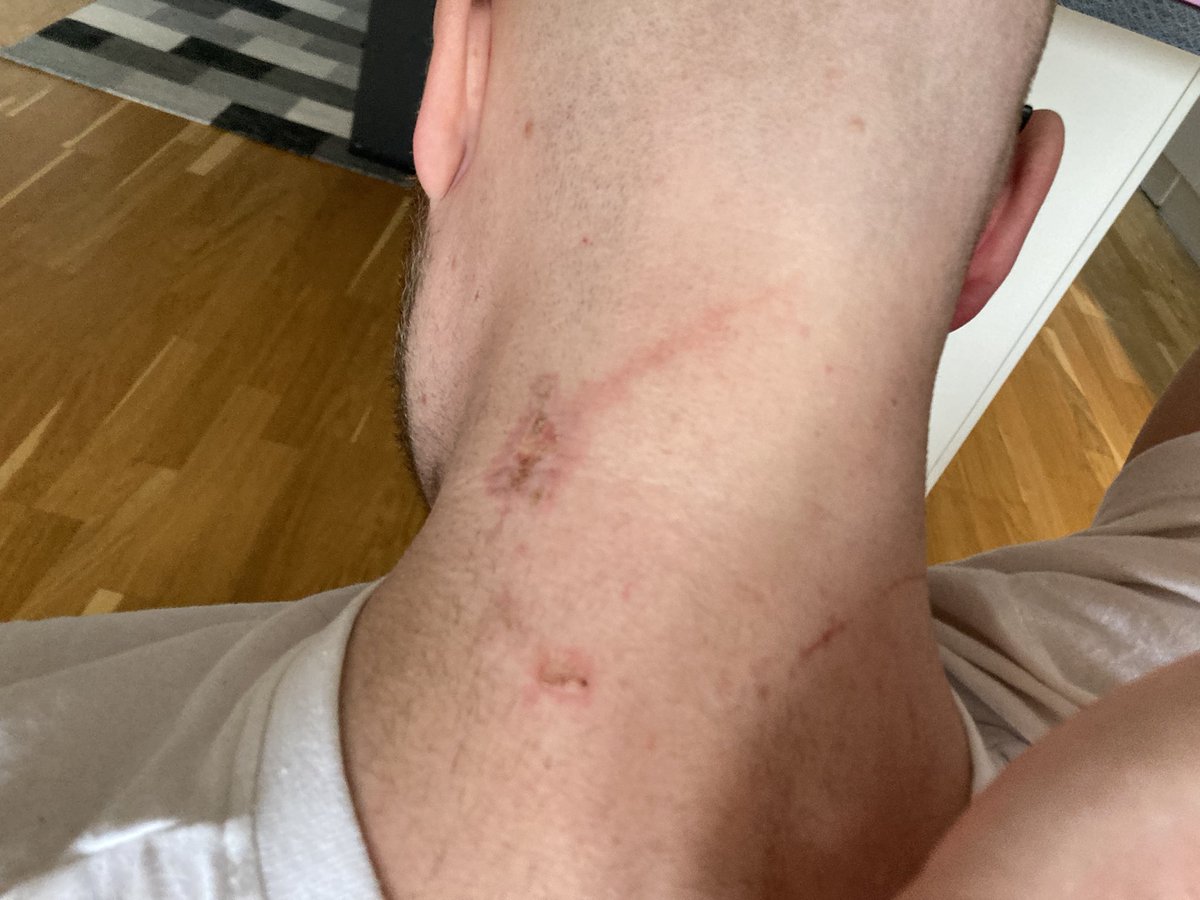 Hittills haft en relativt liberal hållning i frågan om pyroteknik. Igår råkade jag stå framför en person som tillfogade mig brännskador när han tände en bengal. Är det rimligt att man ska behöva riskera att bli skadad för att få se sitt favoritlag live? #fotboll #twittboll