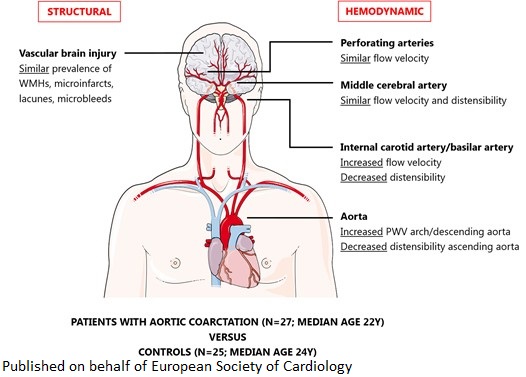 European Society of Cardiology Journals (@esc_journals) on Twitter photo What is the impact of aortic coarctation on cerebral haemodynamics? Read about it in #EHJOpen: doi.org/10.1093/ehjope…
#OpenUpYourScience #CHD #CHDAwareness <a href="/ehjopen/">EHJOpen Editor-in-Chief</a> <a href="/SaDeRosa78/">Salvatore De Rosa</a> <a href="/ProfMagnusBack/">Magnus Bäck</a> <a href="/WernerBudts/">werner budts</a> What is the impact of aortic coarctation on cerebral haemodynamics? Read about it in #EHJOpen: doi.org/10.1093/ehjope…
#OpenUpYourScience #CHD #CHDAwareness <a href="/ehjopen/">EHJOpen Editor-in-Chief</a> <a href="/SaDeRosa78/">Salvatore De Rosa</a> <a href="/ProfMagnusBack/">Magnus Bäck</a> <a href="/WernerBudts/">werner budts</a>
