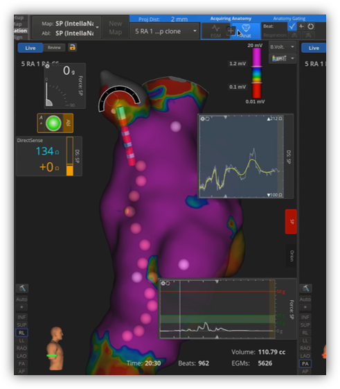 BSC_EU_Heart's tweet photo. Time to simplify your #ultraHD cases with the new system performance and usability features included in Software 5.0 for #RHYTHMIA system.
Curious? Learn more: https://t.co/q90Egu4MLF
#BSCEMEA #EP #Epeeps https://t.co/ueutqF8UHg