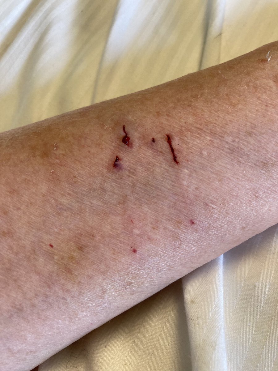 TherapyCatBob's tweet image. I’m going to have to spend some time today making up to mum after I got carried away and left an imprint of my upper teeth arch on her arm. She wasn’t cross with me but I’m feeling a bit ashamed. #CatProblem #BitingMyHuman #oopsie #catscratches #CatsOfTwitter