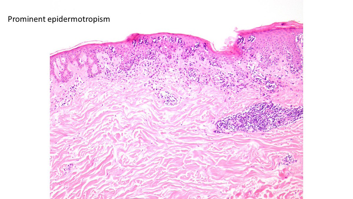 judith_ferry's tweet photo. Check out this case of #Sezary syndrome with skin changes resembling #mycosisfungoides    Differential is with T PLL (but TCL1 was negative and CD7 mostly negative) and ATLL but HTLV1 was negative. #lymphoma #hemepath #dermpath https://t.co/FaZXuND38a