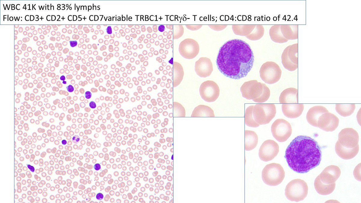 judith_ferry's tweet photo. Check out this case of #Sezary syndrome with skin changes resembling #mycosisfungoides    Differential is with T PLL (but TCL1 was negative and CD7 mostly negative) and ATLL but HTLV1 was negative. #lymphoma #hemepath #dermpath https://t.co/FaZXuND38a