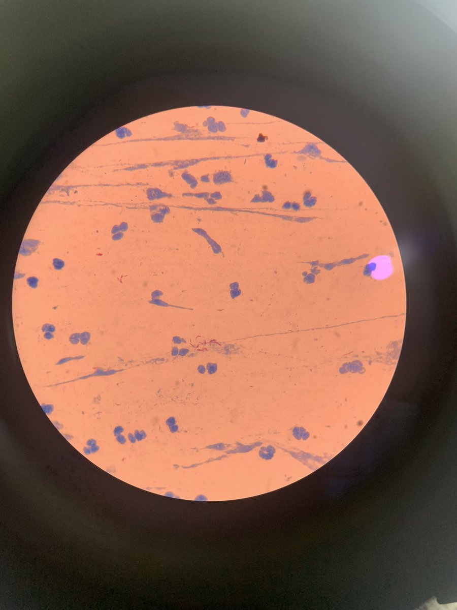 mehersingha's tweet image. Day 3 of our 4 week rotation in St Francis Hospital, Mutolere, Uganda. Follow along for more than just that cool ZN stain at the end (: @UConnIM #GlobalHealth #TropicalDiseases #InfectiousDiseases #IDTwitter #MedTwitter #HealthcareDisparities