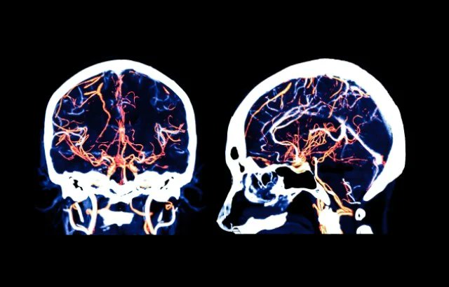 AdePetts's tweet photo. Hope for the first treatment for strokes linked to dementia. Two cheap and common drugs could be re-purposed as the first specific treatment for people who experience a type of stroke linked to nearly half of all dementias.

https://t.co/eC7542rEvi https://t.co/060FkpNHUM