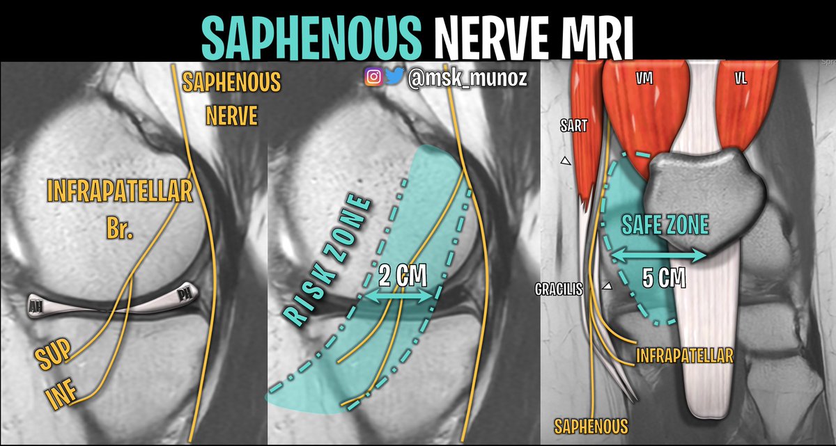 msk_munoz's tweet photo. SAPHENOUS NERVE MRI: 

• Risk of injury during: meniscal surgery (inside out), hamstring harvest and arthroscopy (AM portal)
• Main trunk always identified on MRI. Infrapatellar branch, harder to spot.
• Safe &amp; risk zone depicted (simplified)

#radiology #knee #MRI https://t.co/VPre3UaNGe