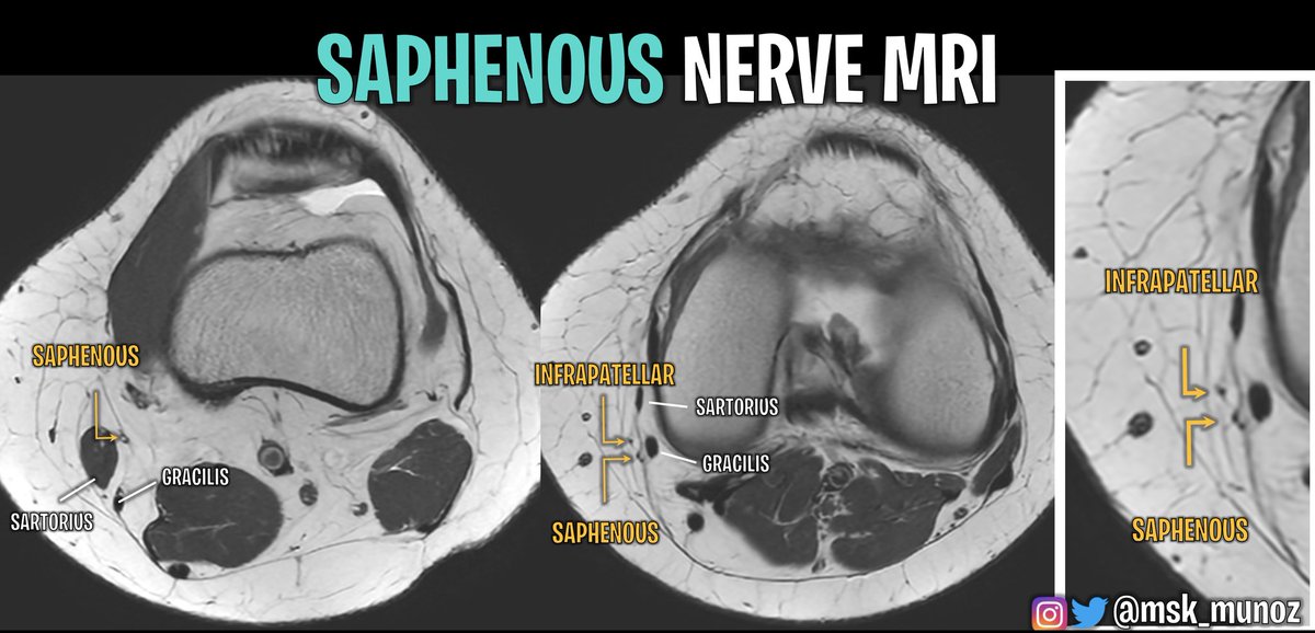 msk_munoz's tweet photo. SAPHENOUS NERVE MRI: 

• Risk of injury during: meniscal surgery (inside out), hamstring harvest and arthroscopy (AM portal)
• Main trunk always identified on MRI. Infrapatellar branch, harder to spot.
• Safe &amp; risk zone depicted (simplified)

#radiology #knee #MRI https://t.co/VPre3UaNGe