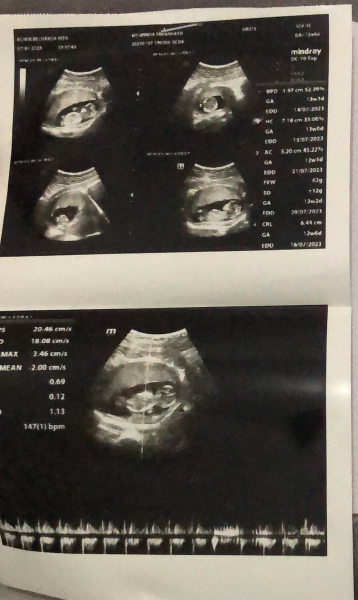 itswindaa's tweet photo. Cintaku, terima kasih karna hari ini kamu lagi dan lagi sudah menunjukkan kalau kamu adalah anak paling kuat 🧡 Maaf ya, Manda masih sering mengeluh karena Manda tidak bisa melakukan hal yang dulu bisa Manda lakuin. https://t.co/vVQqtAMsQw