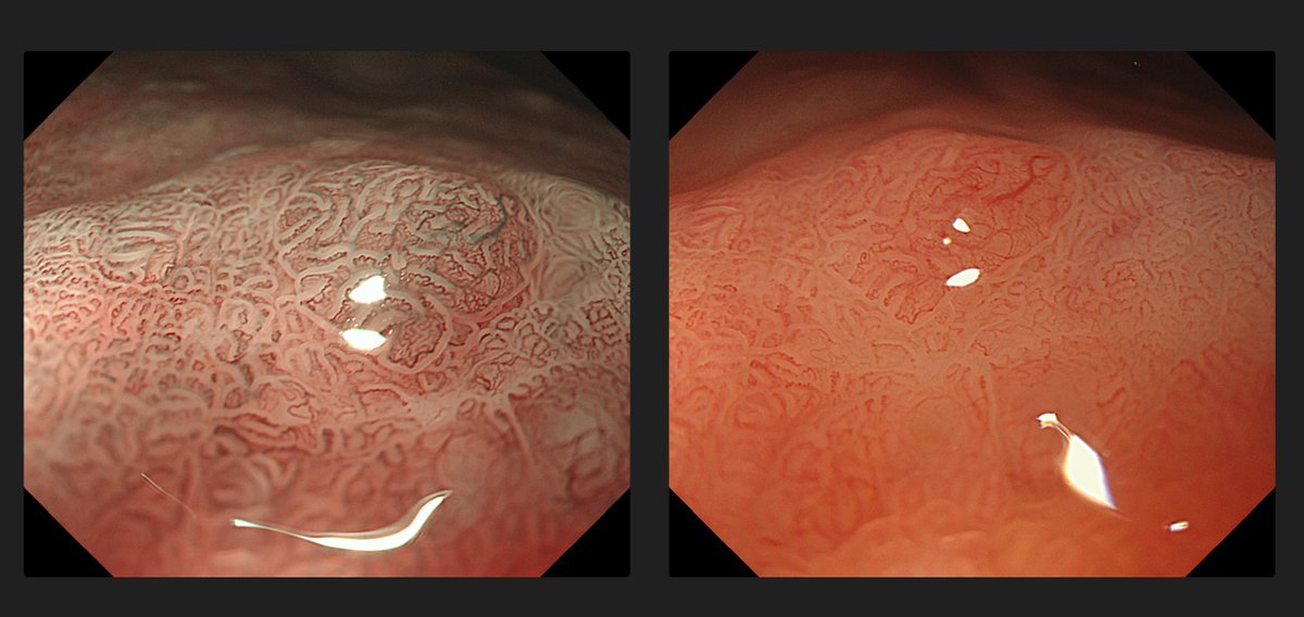 Joaquín Rodríguez | 🔎Endoscopia digestiva tweet media