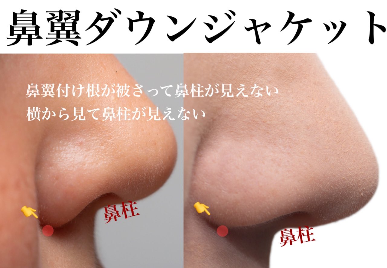 鼻整形の執刀医選び🏥鼻フル、鼻尖形成、目頭切開、鼻中隔延長