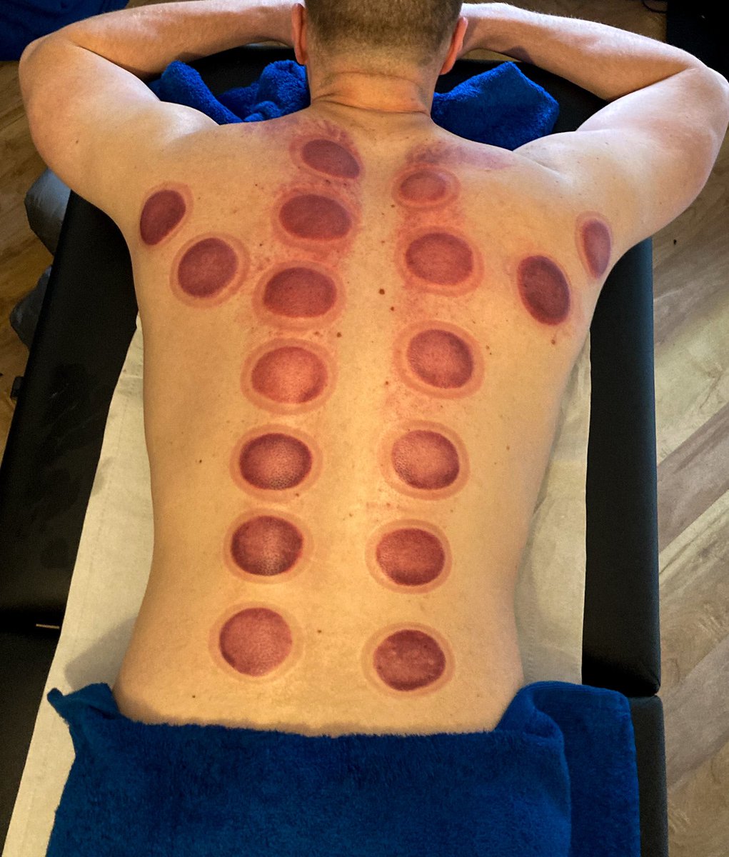 Myofascial Dry Cupping 

Benefits include greater range of motion, reduced pain/tension and better sleep 

Book your appointment now! 

#sleaford #Lincolnshire #lincs #sportsmassage #massage #drycupping #cupping #myofascialrelease #appointments #booknow #book