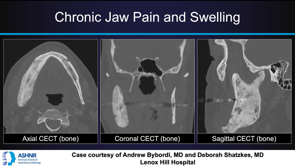 ASHNR (@ashnrsociety) on Twitter photo #ASHNRCOTW #213: Chronic jaw pain & swelling. Dx? Thx Drs. Bybordi & <a href="/DShatzkes/">Deborah Shatzkes</a> 4 case! #ASHNR23
Answer w/ appropriate GIF only -- stay professional & don't spoil it!
<a href="/nancyfstanford/">Nancy Fischbein</a> <a href="/callyrobs/">Caroline Robson, MBChB</a> <a href="/CDP_Rad/">C Douglas Phillips 🇺🇸</a> <a href="/rhwiggins/">Richard Wiggins</a> <a href="/nakoontz/">Nicholas Koontz</a> <a href="/cmtomblinson/">Courtney Tomblinson, MD</a> <a href="/WmOBrienDO/">William T. O'Brien, DO 🧠🩻</a> <a href="/ESHNRSociety/">ESHNR</a> <a href="/tabby_kennedy/">Tabby A. Kennedy, MD</a> #ASHNRCOTW #213: Chronic jaw pain & swelling. Dx? Thx Drs. Bybordi & <a href="/DShatzkes/">Deborah Shatzkes</a> 4 case! #ASHNR23
Answer w/ appropriate GIF only -- stay professional & don't spoil it!
<a href="/nancyfstanford/">Nancy Fischbein</a> <a href="/callyrobs/">Caroline Robson, MBChB</a> <a href="/CDP_Rad/">C Douglas Phillips 🇺🇸</a> <a href="/rhwiggins/">Richard Wiggins</a> <a href="/nakoontz/">Nicholas Koontz</a> <a href="/cmtomblinson/">Courtney Tomblinson, MD</a> <a href="/WmOBrienDO/">William T. O'Brien, DO 🧠🩻</a> <a href="/ESHNRSociety/">ESHNR</a> <a href="/tabby_kennedy/">Tabby A. Kennedy, MD</a>