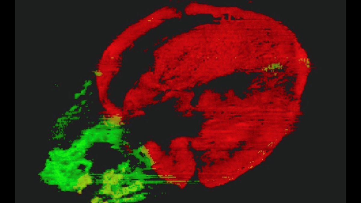 Human BioMolecular Atlas Program (HuBMAP) (@_hubmap) on Twitter photo Take heart! <a href="/_hubmap/">Human BioMolecular Atlas Program (HuBMAP)</a> researcher Taruna Neelakantan <a href="/Columbia/">Columbia University</a> poured her heart out in making this DESI-MSI image showing the spatial distribution of fatty acids in a heart for #nationalheartmonth. So, donât lose heart, you can have an image of ours! â„ #womeninscience #imaging_ms Take heart! <a href="/_hubmap/">Human BioMolecular Atlas Program (HuBMAP)</a> researcher Taruna Neelakantan <a href="/Columbia/">Columbia University</a> poured her heart out in making this DESI-MSI image showing the spatial distribution of fatty acids in a heart for #nationalheartmonth. So, donât lose heart, you can have an image of ours! â„ #womeninscience #imaging_ms