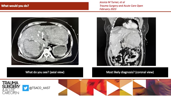 TSACO_AAST's tweet photo. (1/4) #WWYDWEDNESDAYS! π§
CASE: 31F with Down syndrome, hypothyroidism, and 13 yrs of OCP use presents to ED s/p syncope found to be in #hemorrhagic #shock.
What's the diagnosis?
#TSACOGLOBAL #SoMe4Trauma #SoMe4Surgery https://t.co/Iq8zYpqWeW
