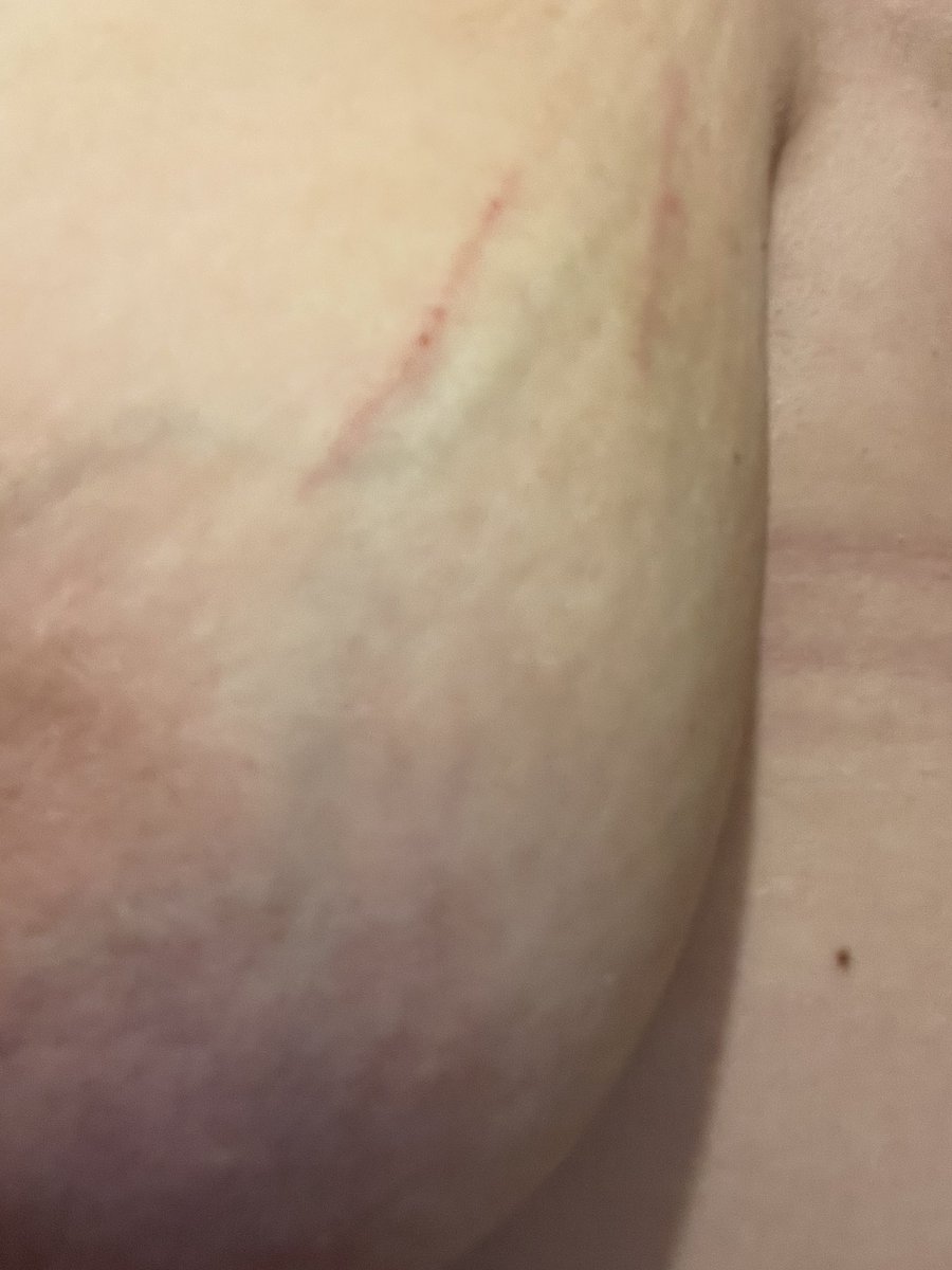 luciole738's tweet photo. Je sais pas ce qu’il sais passer en une nuit on m’a griffé c’est pas dans mes rêves 😂 #sein #bdsm #griffer https://t.co/AAYcFBIWeT