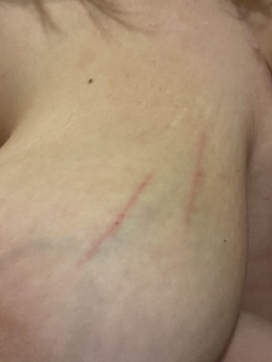 luciole738's tweet photo. Je sais pas ce qu’il sais passer en une nuit on m’a griffé c’est pas dans mes rêves 😂 #sein #bdsm #griffer https://t.co/AAYcFBIWeT