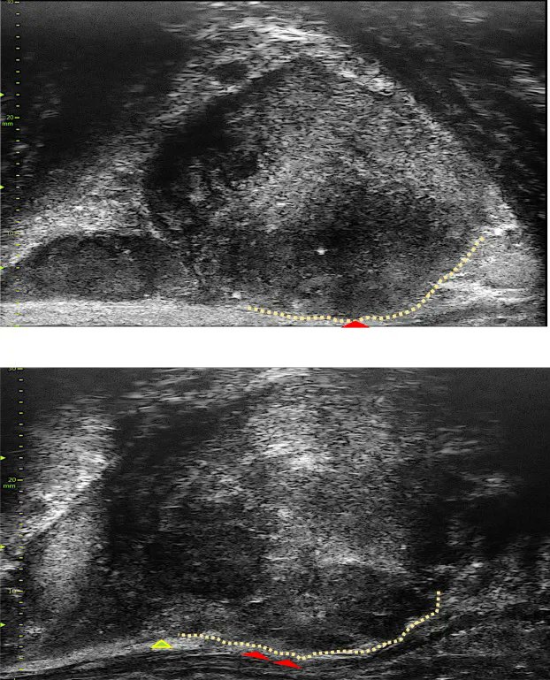 EurUrolOpen's tweet photo. Current Issue: Side-specific, Microultrasound-based Nomogram for the Prediction of Extracapsular Extension in Prostate Cancer 

https://t.co/KkSedsThxv 

@PedrazaAdrianaM @parekh_sneh @GrauerRalph @VinayakWagaskar @FloraBarthe @drutizzo @michael_gorin @MMenonMD 

#prostatecancer https://t.co/A7teaWyqL1