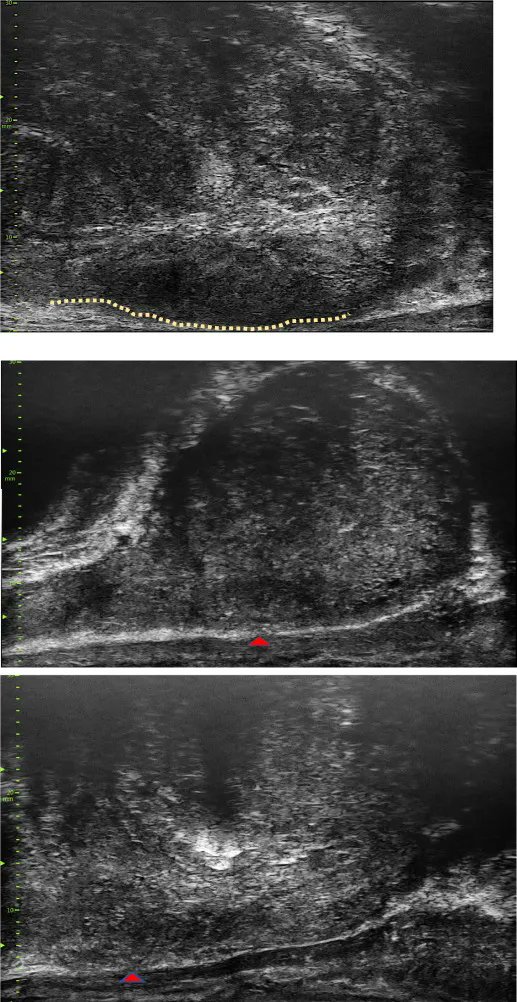 EurUrolOpen's tweet photo. Current Issue: Side-specific, Microultrasound-based Nomogram for the Prediction of Extracapsular Extension in Prostate Cancer 

https://t.co/KkSedsThxv 

@PedrazaAdrianaM @parekh_sneh @GrauerRalph @VinayakWagaskar @FloraBarthe @drutizzo @michael_gorin @MMenonMD 

#prostatecancer https://t.co/A7teaWyqL1