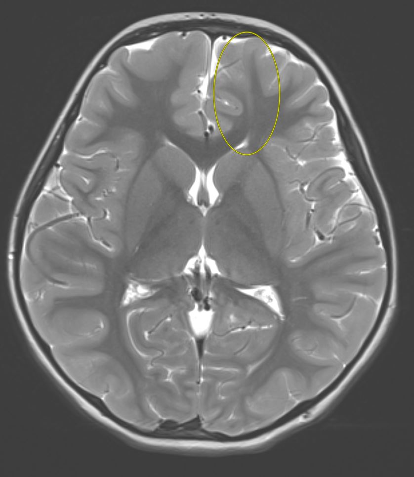 Tip of the day 💡: Spend time optimizing your axial T2 sequence- still the bread and butter sequence for us #radiologists! Here one should pick up the focal cortical dysplasia instantly with the characteristic tail sign. Case closed!