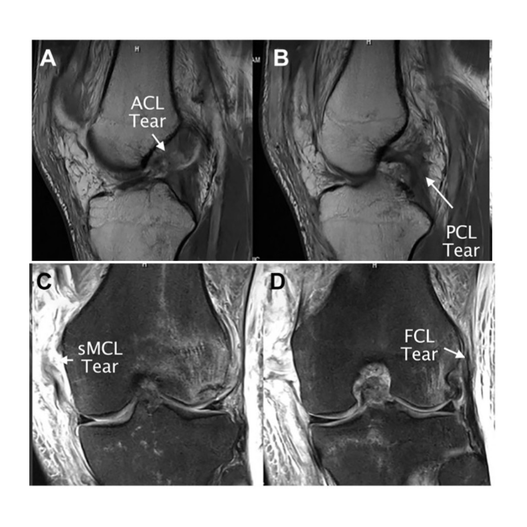 The diagnostic accuracy of MRI for multi-ligament knee injuries (#MLKIs) varies considerably among knee structures, with a high risk for misdiagnosis of the #PLC, #meniscus, or chondral lesions.  ow.ly/PPF850MQfvI
<a href="/sancheztrauma/">sanchez </a> <a href="/beatrixlh/">Ivana Kartika Dewi</a> <a href="/pacorro581/">FRANCISCO FIGUEROA B</a> <a href="/CEspregueira/">Clínicas Espregueira</a>  #knee