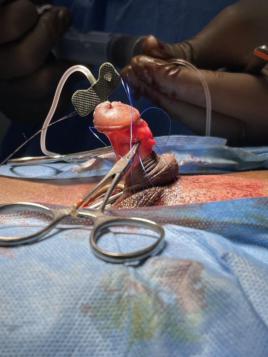 Avoid complete mobilisation of the NV bundle . Our stitches are at 11 and 1 o clock , most convex border of Corpora . <a href="/SocietyGURS/">GURS</a> <a href="/brurology_group/">Brazilian Reconstructive Urology Group</a> <a href="/Uroweb/">European Association of Urology (EAU)</a> <a href="/AmerUrological/">Amer. Urol. Assn.</a> <a href="/USANZUrology/">USANZ</a>