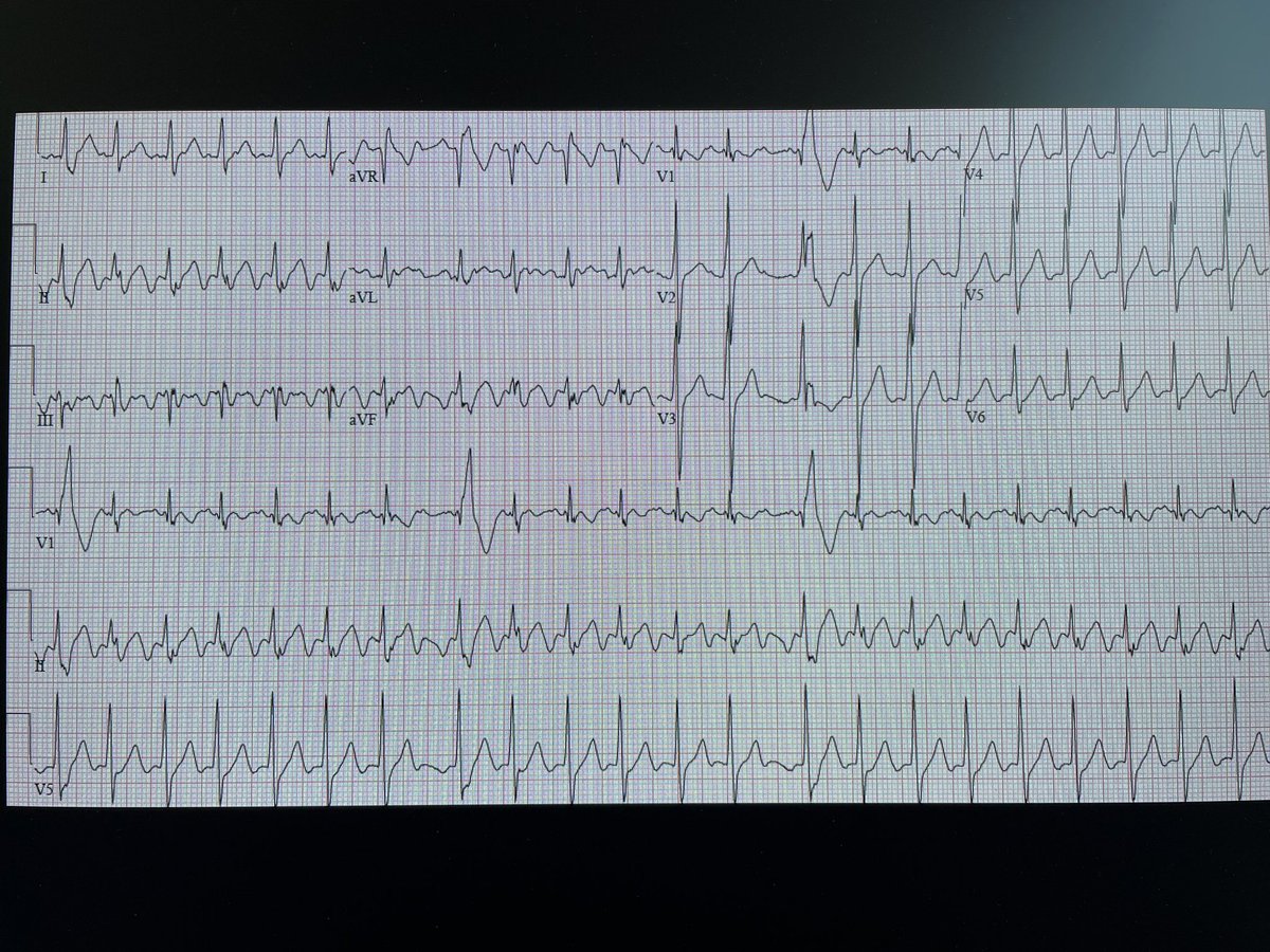 #EPFellows and #CardiologyFellows tell me about the mechanism of wide beats on this ECG #CardioTwitter #EPeeps