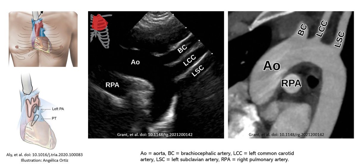 Suprasternal #echofirst view
#POCUS #MedEd #FOAMcc