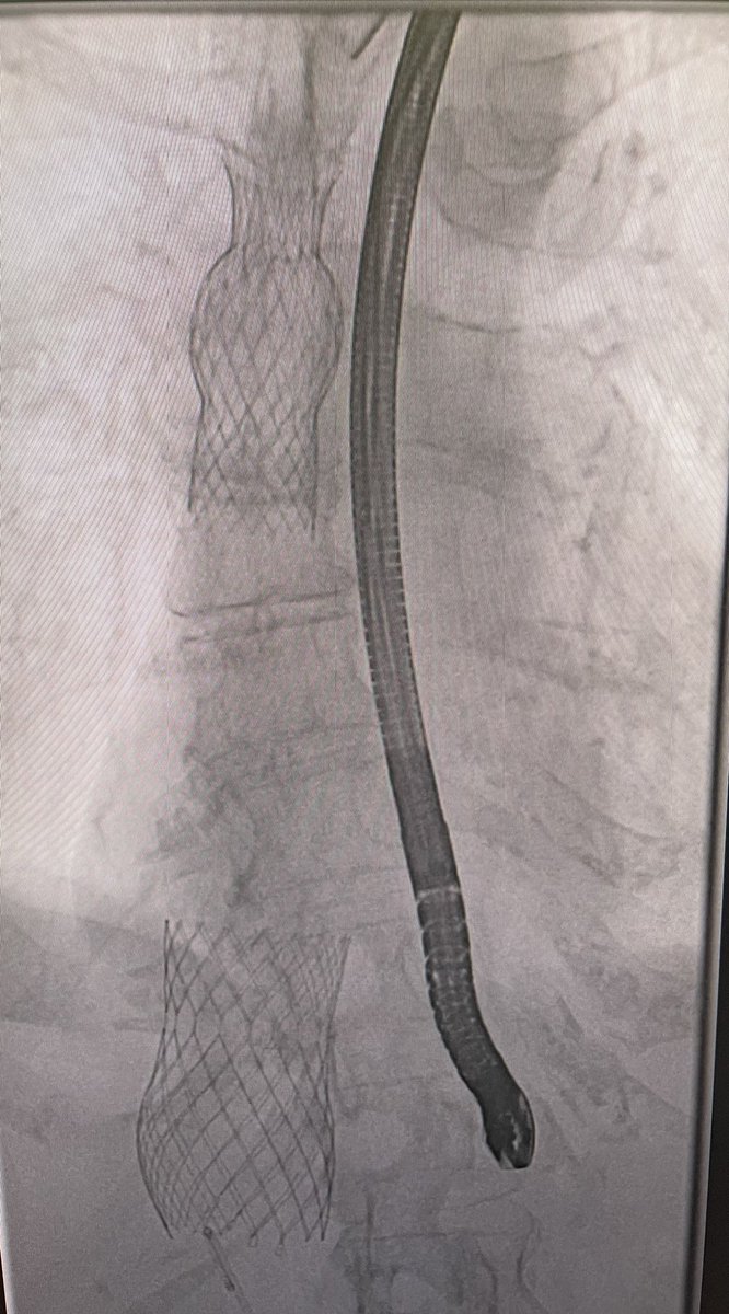 First TricValve cases in Texas. Promising technology for TR. @HMethodistCV @MReardon19 @SLittleMD @NadeenFaza @tavrkapadia #RishiPuri @PaulShe86887391 @PradeepYadavMD @GilbertTangMD @akcmahi @hahn_rt @azeemlatib