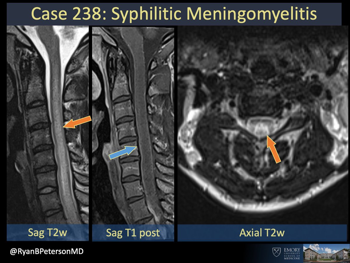 Ryan B Peterson 🇸🇪 on Twitter "Answer Syphilitic Meningomyelitis