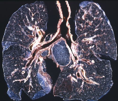los pulmones de descartes: