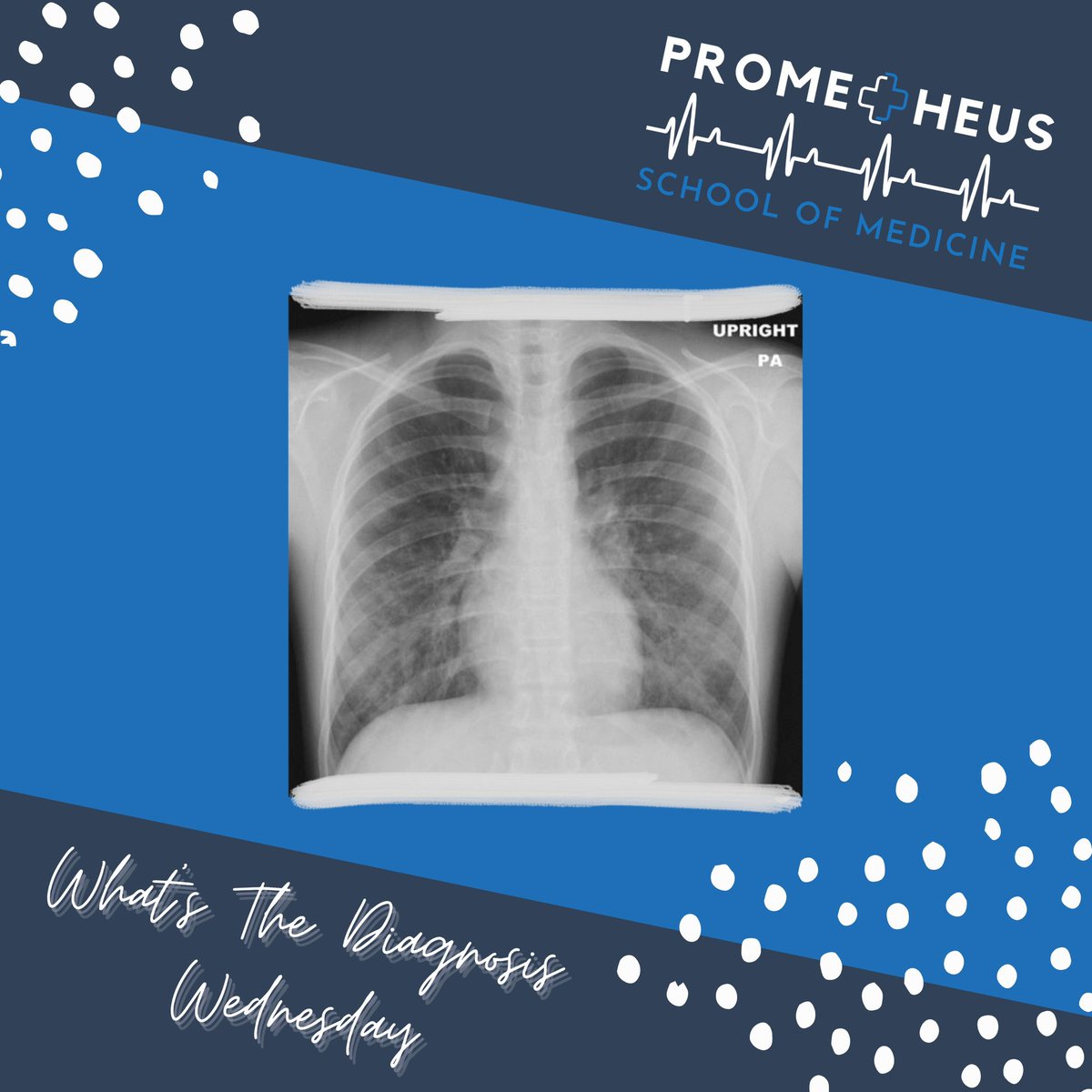 Prometheus_Med's tweet photo. Today is “What’s the Diagnosis Wednesday”! Comment below what you might think the diagnosis is before swiping to see the answer! 
•
•
#medicine #diagnosis #prehealth #wednesday #physician #medicine #doctor #nurse #physicianassistant https://t.co/Onb8torRau