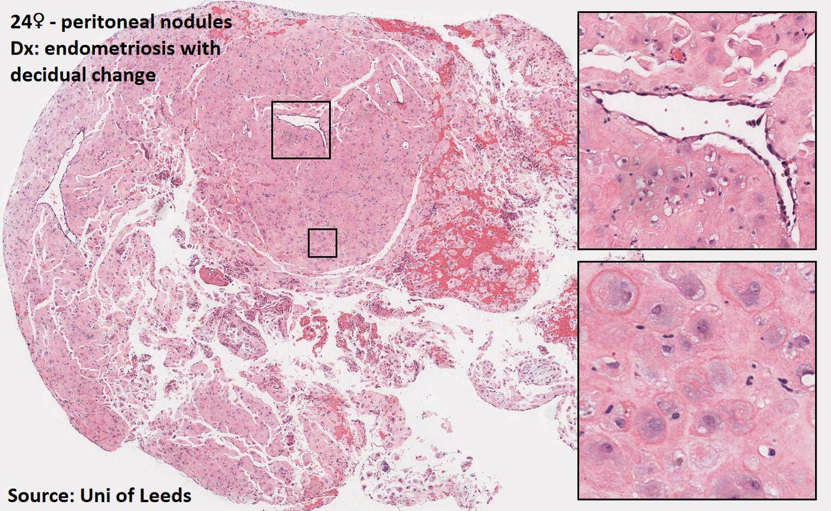 DrTravisBrown's tweet photo. Histology flash card
Endometriosis
~10% reproductive age♀
Risk factors:
-FHx
-Early menarche
-Late menopause
-Nulliparity
-Heavy menstrual bleeding
Locations
Ovary/ovarian fossa 67% & 32%
Uterosacral ligaments 46%
Pouch of Douglas 30%
Bladder 21%
Ep 19 #ThisPathLife #podcast https://t.co/Pke5T94TxF