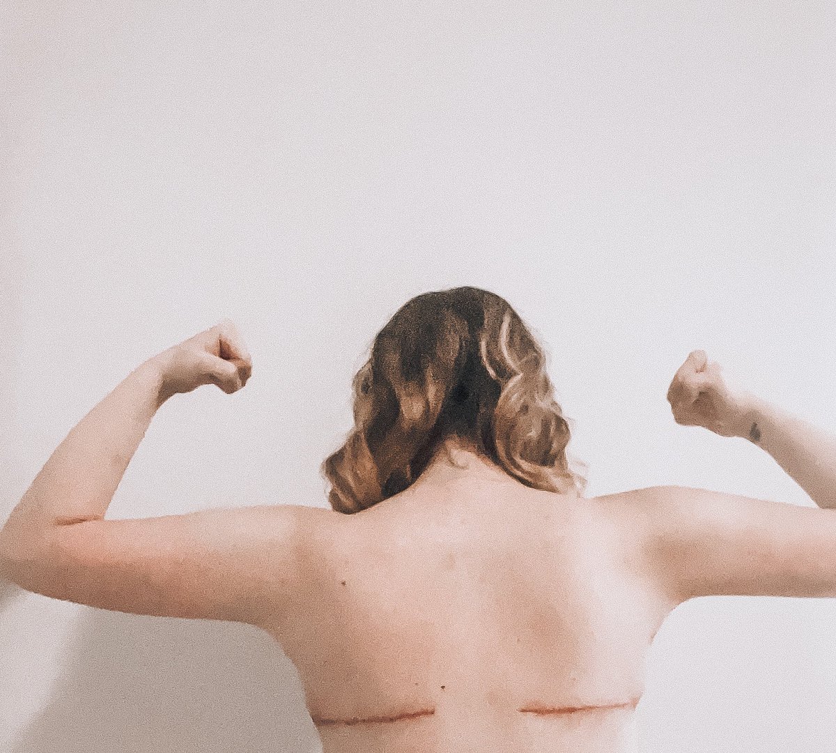 katelynn_babe's tweet photo. Update: In October I had my first loose skin removal procedure. Upper body : brachialplasty (arm skin removal elbow to armpit, boob lift and reduction and bra strap skin removal. Here some results. https://t.co/HE5yZOdW7X