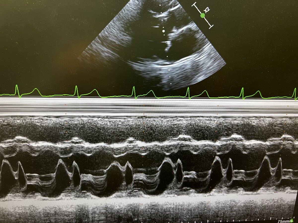 JDDCFratti's tweet image. #MVP MITRAL VALVE PROLAPSE: prevalence 0.6-3%. Primary vs Sec (IE, etc). Click- holosystolic murmur. Systolic billowing &amp;gt;2mm above annular plane. Mid-late systolic MR. M mode mitral valve prolapse. 🩺 first the #firstecho @MattersoftheH14 @ASE360 @EmergencyEcho @echocardiac