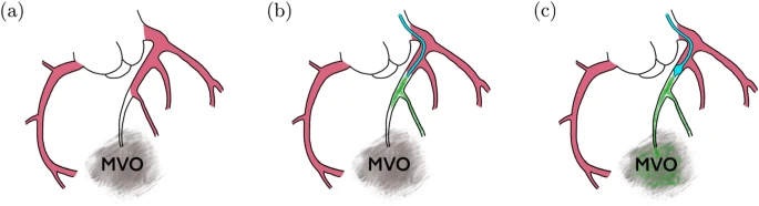 CVE_ARTORG's tweet photo. Efficient drug delivery to cardiac microvascular obstructions? A novel technology using a multi-lumen catheter ... read more: https://t.co/47QaXWTcTm
@unibern @CorFlowAG https://t.co/y3oHL4JmDg