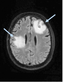 MRI de cerebro con masas blancas y flechas indicando esas masas.