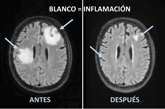 Imagen de MRI de cerbro con masas blancas y flechas. Las masas casi han desaparacido por completo tras el tratamiento. Adaptada de N. SPOTTISWOODE ET AL., EMERG. INFECT. DIS. (1) 197-201 (2023)