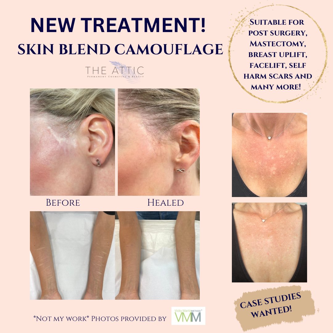 The Attic Permanent Cosmetics & Beauty (@attictanning) on Twitter photo Skin blend scar camouflage now available!
@medicaltattooartists <a href="/VickyMMethod/">Vicky Martin Nipple Artist</a> <a href="/RCHTWeCare/">Royal Cornwall Hospitals NHS Trust</a> <a href="/WadebridgeLocal/">Wadebridge People</a> Skin blend scar camouflage now available!
@medicaltattooartists <a href="/VickyMMethod/">Vicky Martin Nipple Artist</a> <a href="/RCHTWeCare/">Royal Cornwall Hospitals NHS Trust</a> <a href="/WadebridgeLocal/">Wadebridge People</a>