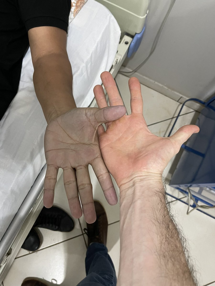 delpynews's tweet image. ▶️ JAJEPOHEI | 😂

El dr. @AleGinzo_MD, contó una anécdota simpática que al parecer le tocó vivir en consultorio con un joven paciente que llegó con las manos azuladas a urgencias.😱

¿El diagnóstico?👉el paciente solo se secó las manos por su jean nuevo.​🤐