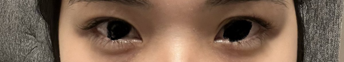 aooooo1_'s tweet photo. 左目の目頭だけライン残りすぎてて左右差えぐい🙄
傷跡でかいからなくなるまでけっこうかかりそう… https://t.co/HfciCYZJiN