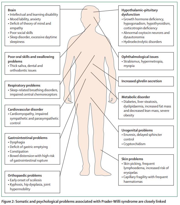 TheLancetEndo's tweet photo. Endocrine disorders in Prader-Willi syndrome: a model to understand and treat #hypothalamic dysfunction https://t.co/ApVUI4MIbR 
#praderwilli #pws #hyperphagia #obesity https://t.co/JIXLH1tBwA