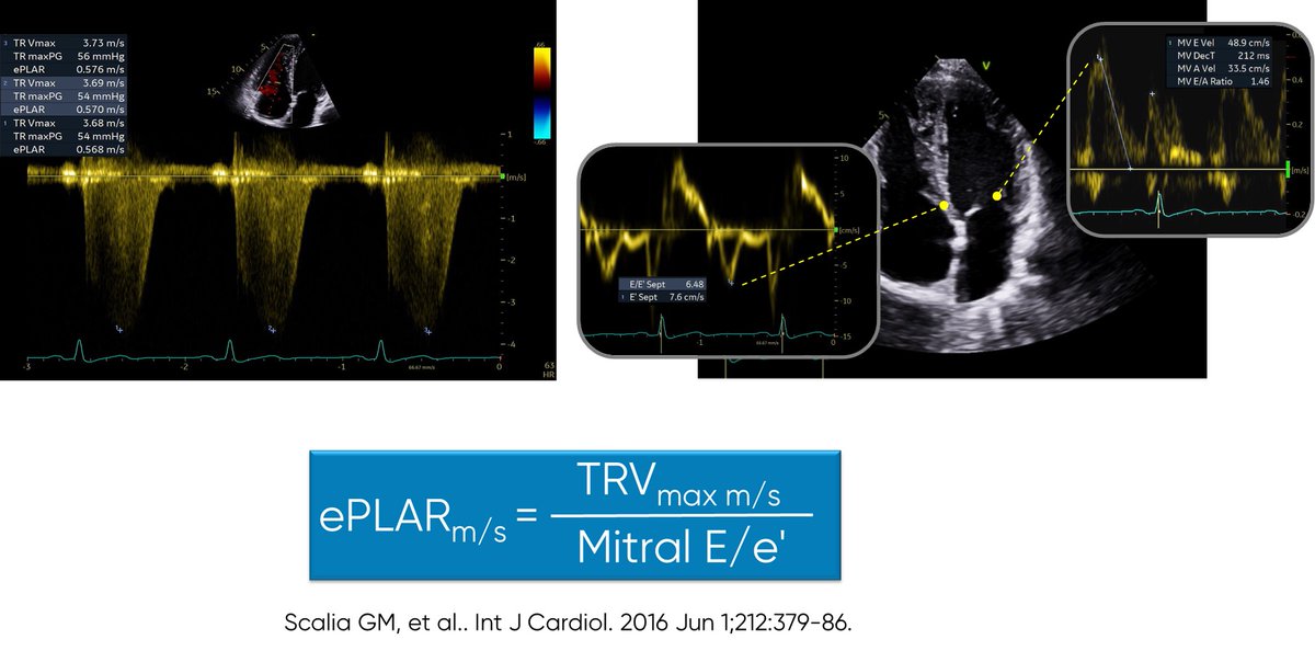 Bonita Anderson (@bonitaecho) on Twitter photo Echo in COVID-19:
🔥Hot off the press.... ePLAR (TRVmax divided by mitral E:e' septal) reported as a powerful prognostic tool in COVID-19 patients - especially when PASP is elevated.
See: ncbi.nlm.nih.gov/pmc/articles/P…
@ase360 #echofirst <a href="/ScaliaGreg/">Greg Scalia</a> Echo in COVID-19:
🔥Hot off the press.... ePLAR (TRVmax divided by mitral E:e' septal) reported as a powerful prognostic tool in COVID-19 patients - especially when PASP is elevated.
See: ncbi.nlm.nih.gov/pmc/articles/P…
@ase360 #echofirst <a href="/ScaliaGreg/">Greg Scalia</a>