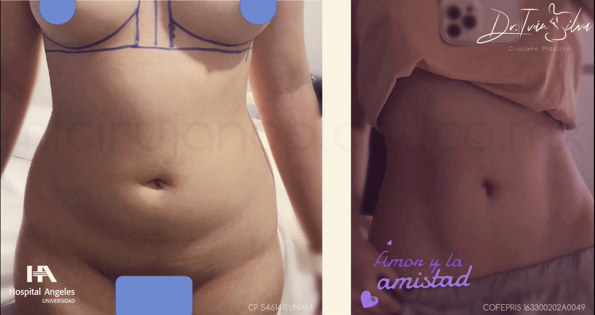drsilvaplastica's tweet photo. la #liposuccion se puede hacer con #heus y #dorian para obtener mejores resultados 👌✅🙏 sobre todo en el #marcajeabdominal ✅✅
se recomienda 1 semana de reposo en casa
#drivansilvacirugiaplastica
#cirujanoplasticocertificado
#plasticsurgery https://t.co/gD2FU7a7r1
