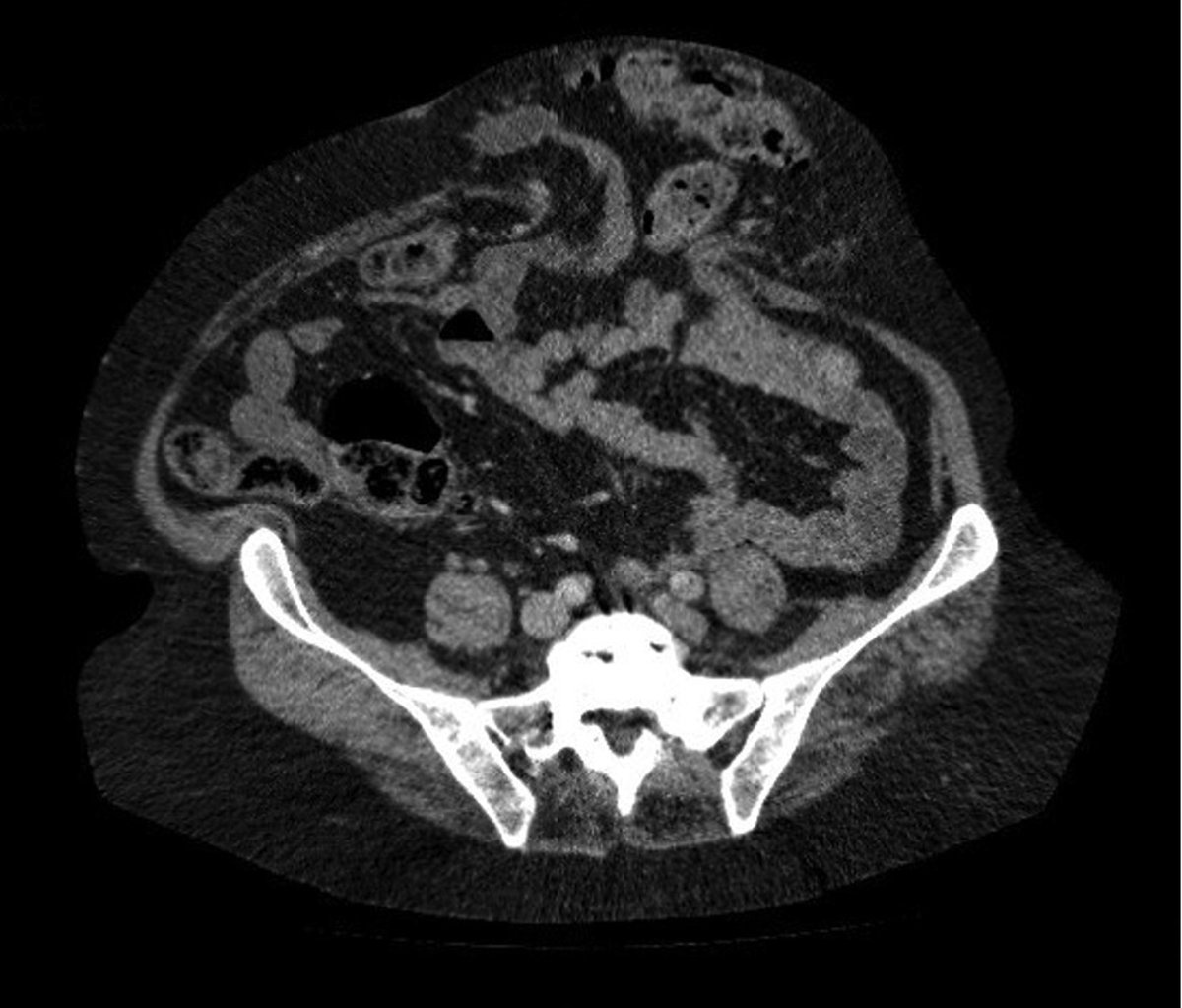 In the BJS March issue: Contemporary management of parastomal hernia academic.oup.com/bjs/article/11… @bplwijn @des_winter @ksoreide @MalinASund @evanscolorectal @nfmkok @paulo_sutt @robhinchliffe1 @young_bjs