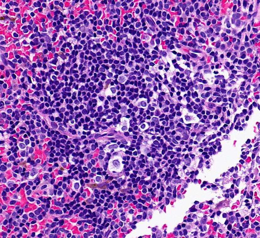 SibaElHussein's tweet image. Autoimmune myelofibrosis:

🩸Defined as marrow fibrosis &amp;amp; lymphocytic aggregates in the context of an established autoimmune disorder (secondary) or autoantibodies without a defined disorder (primary)

#hemepath #pathtwitter #leusm #bmtsm #BMT