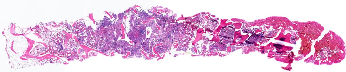 SibaElHussein's tweet image. Autoimmune myelofibrosis:

🩸Defined as marrow fibrosis &amp;amp; lymphocytic aggregates in the context of an established autoimmune disorder (secondary) or autoantibodies without a defined disorder (primary)

#hemepath #pathtwitter #leusm #bmtsm #BMT