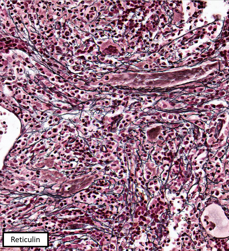 SibaElHussein's tweet image. Autoimmune myelofibrosis:

🩸Defined as marrow fibrosis &amp;amp; lymphocytic aggregates in the context of an established autoimmune disorder (secondary) or autoantibodies without a defined disorder (primary)

#hemepath #pathtwitter #leusm #bmtsm #BMT