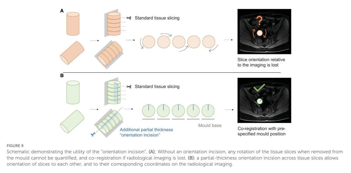 🚨 Heartiest kudos to @MariaBioeng @MarikaReinius & team on their fantastic @FrontOncology publication & work on developing a computational pipeline for lesion-specific 3D-printed moulds to guide multi-sampling of ovarian tumours! Incredible 👏 More here: doi.org/10.3389/fonc.2…