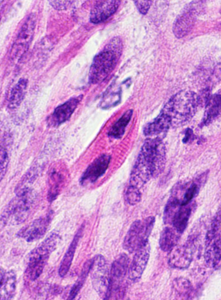 JMGardnerMD's tweet photo. What are the pink cells? What tumors can you find them in?
More pics &amp; Answer ✅ https://t.co/Wi6GKxe2Zq
Another example: https://t.co/hhWikyVE6T
Videos ⏯️ https://t.co/UNeMkqiUX5 &amp; https://t.co/5zbepxcRsu
#BSTpath #pathologists #pathology #pathTwitter https://t.co/SFm2LUZLnR